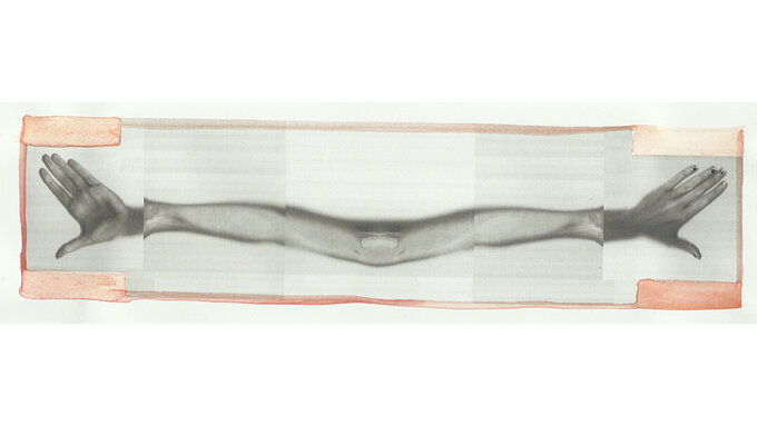 Two X-rayed arms connected at the upper arm in a straight line